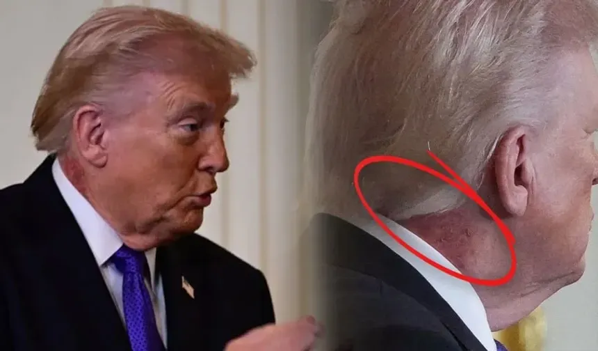 Trump'ın boynundaki morluklar gündem oldu!
